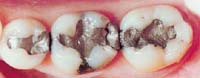 Amalgam Fillings Image