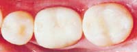 Amalgam Replacement Image