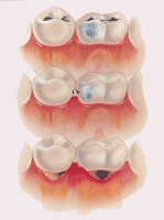 Dental Caries