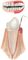 Gingivitis Image