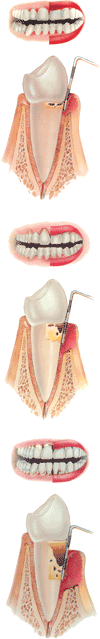 Periodontitis Image
