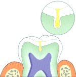 Fissure Seal image3
